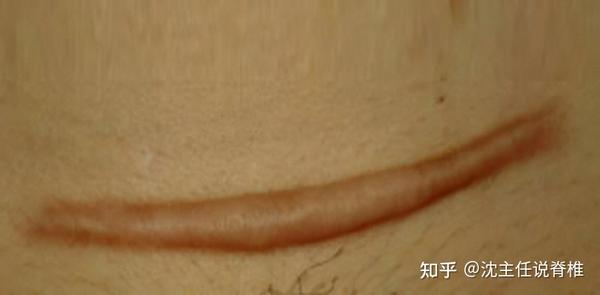 剖腹产后，肚子上的疤痕如何进行按摩处理？ - 知乎