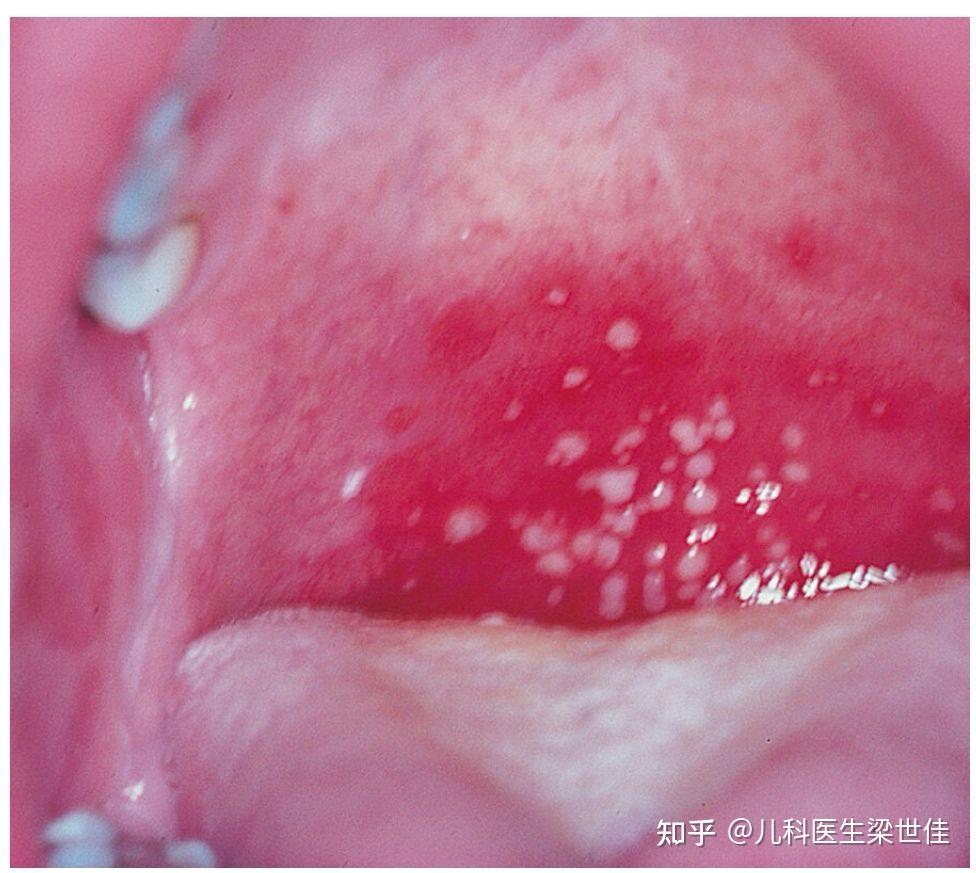 先看下面这张图片:一名患有严重喉咙痛的青少年软腭上的疱疹性咽峡炎