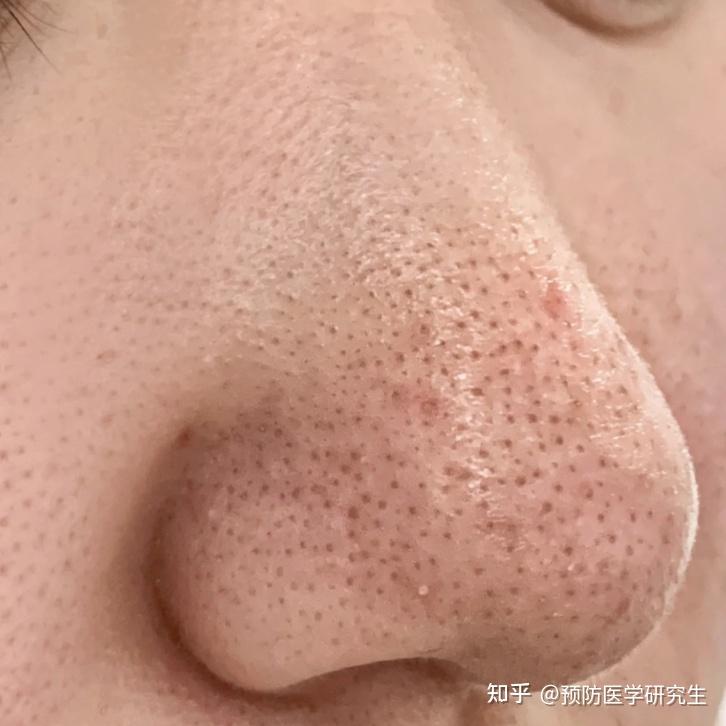 专业医生保姆级去黑头方法!千万别用暴力方式去黑头了,安全去黑头仅需4步,一个月养成牛奶鼻!拒交智商税! - 知乎