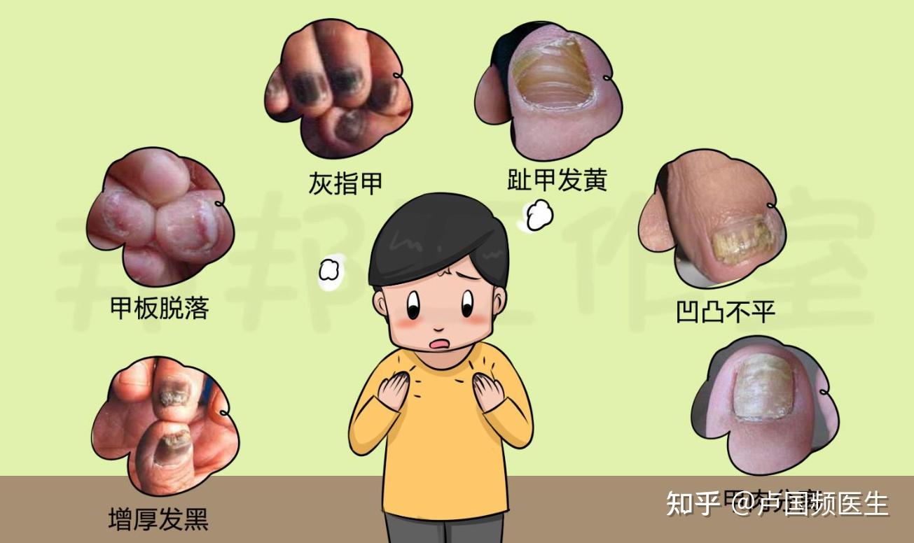 得了灰指甲该怎么治?教你3个绝招,简单方便,勇敢对灰指甲说不 - 知乎