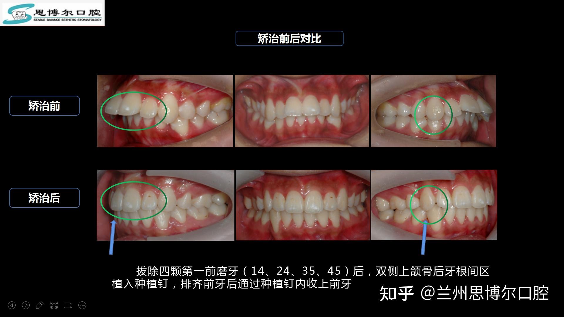 重度深覆蓋齙牙伴上牙上唇前突的拔牙矯治案例