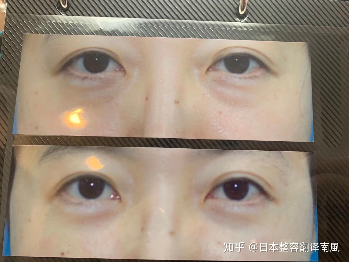 北京眼袋科普：祛眼袋后为什么有淤青？大概需要多长时间可消失？ - 知乎