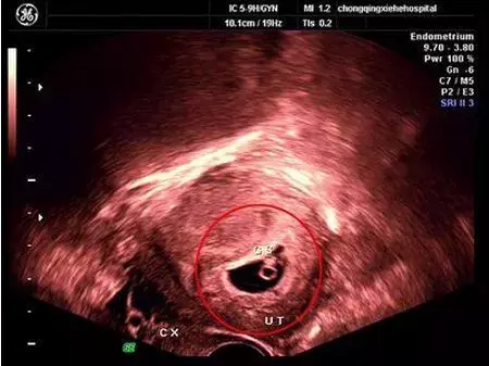 试管婴儿移植成功后 孕囊 胎心 胎芽多久能看见 知乎