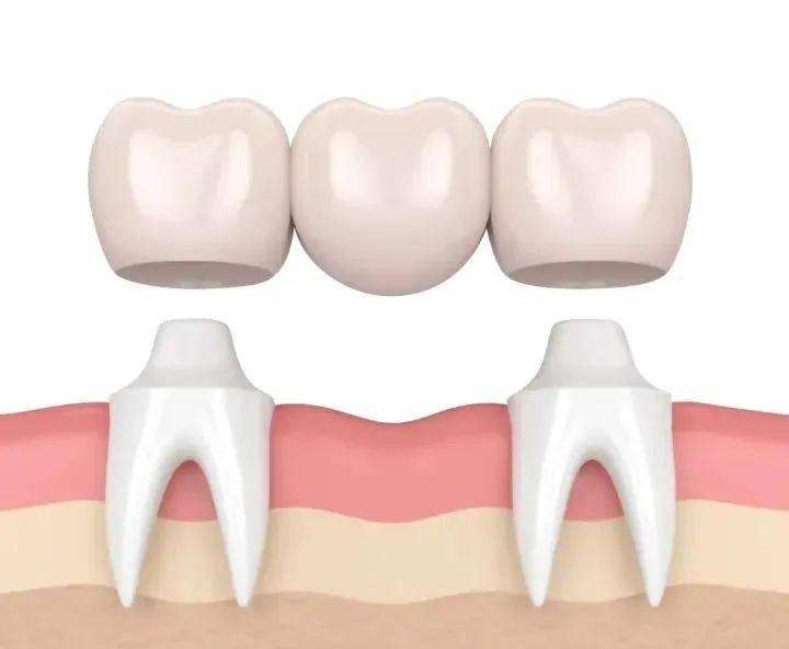 個以上的牙冠連在一起,再與相應個數的種植體連接的一種牙齒修復方式