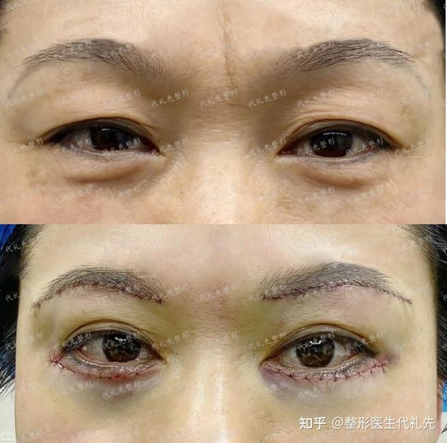 提眉手术多久疤痕会完全消失上眼睑松弛下垂眼尾下垂三角眼