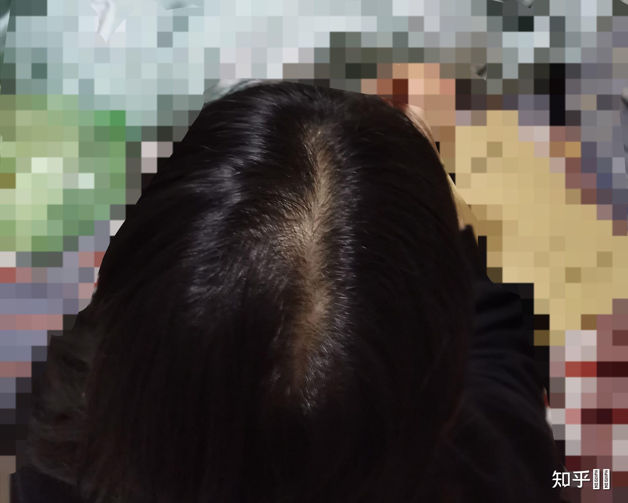 本来后脑勺上有两个旋,加上头发不多,就像个字母y,平时根本不敢披着