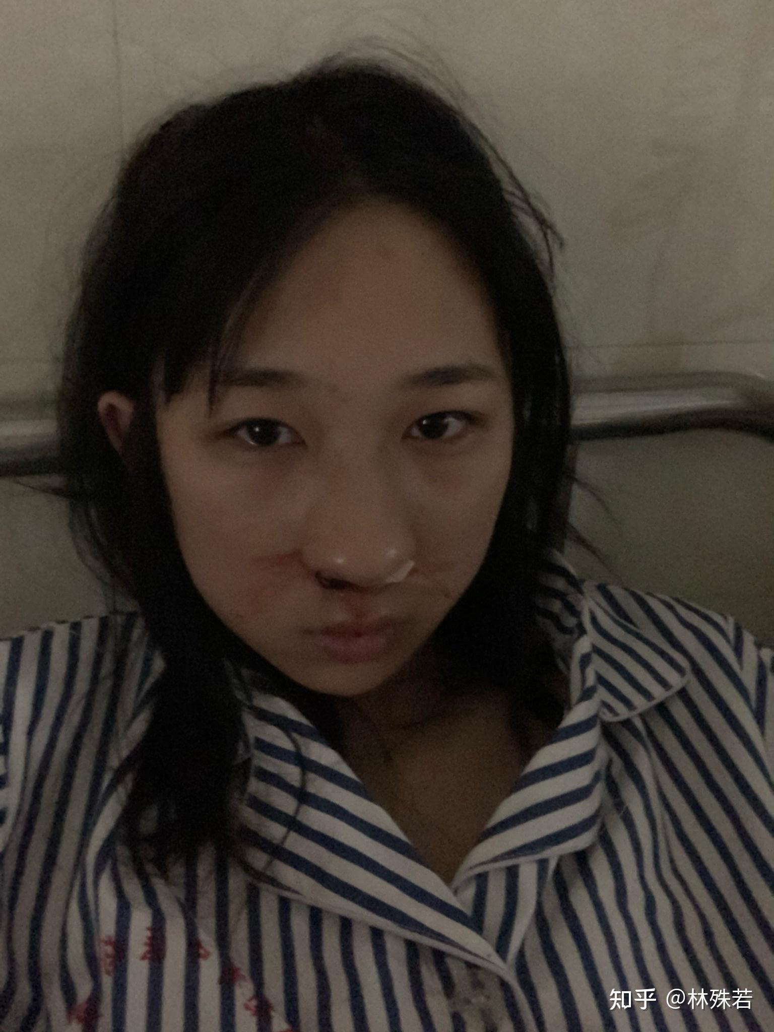 鼻中隔偏曲手术要注意什么!