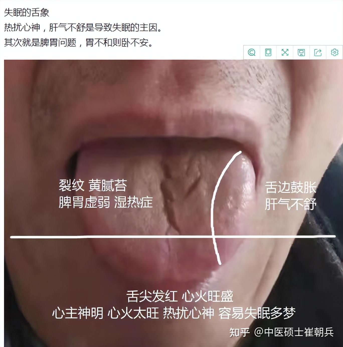 正常人的舌头红点图片,梅毒舌头早期症状图片 - 伤感说说吧