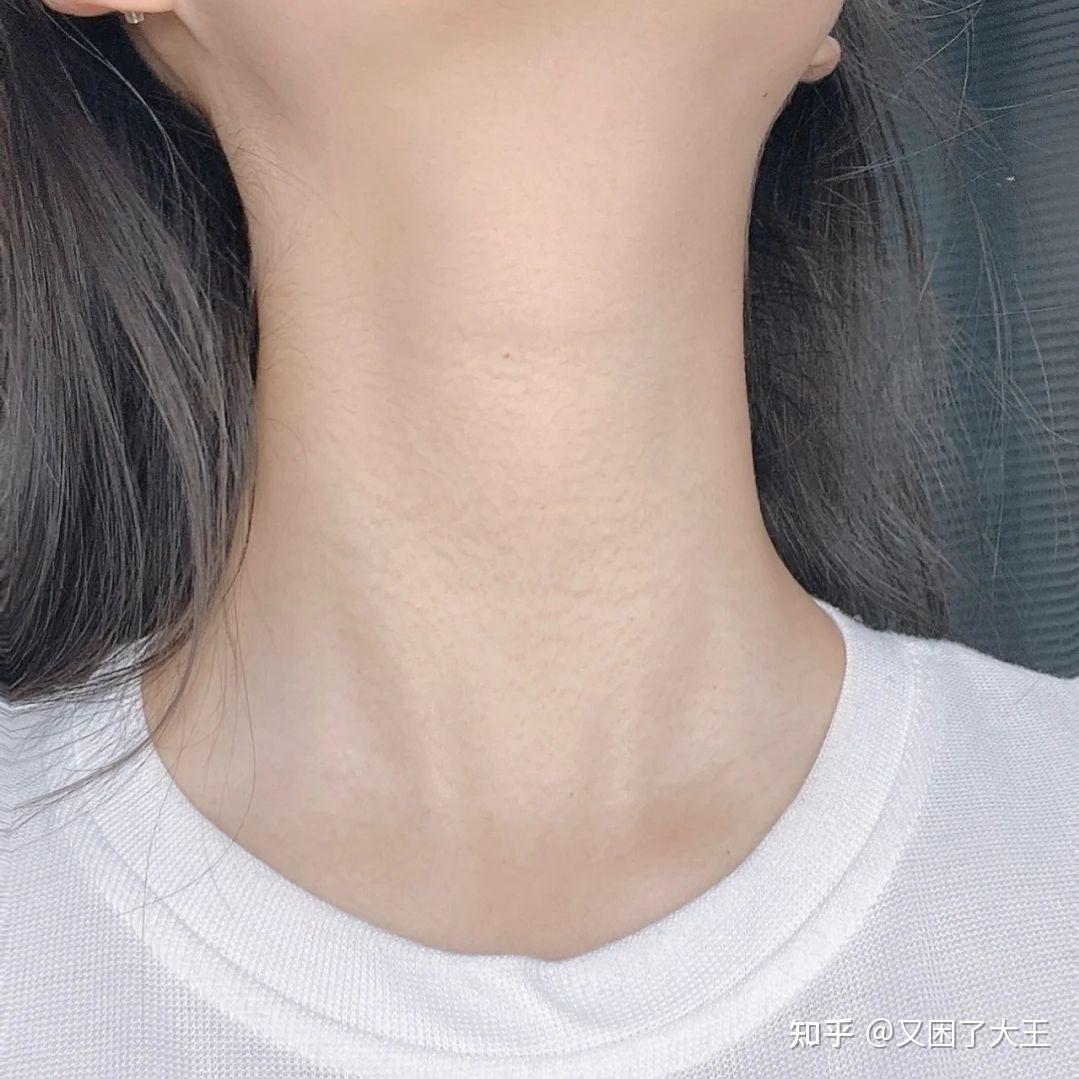 脖子上出现这样的纹路可千万要注意_颈部_颈椎_皮肤
