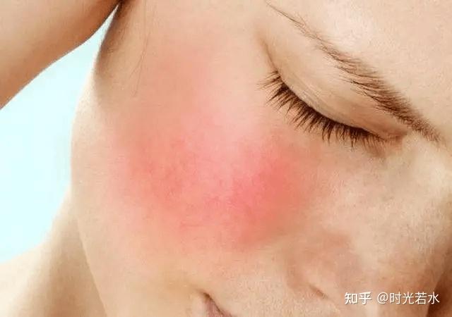 怎么判断自己脸是不是敏感肌多久可以恢复敏感肌