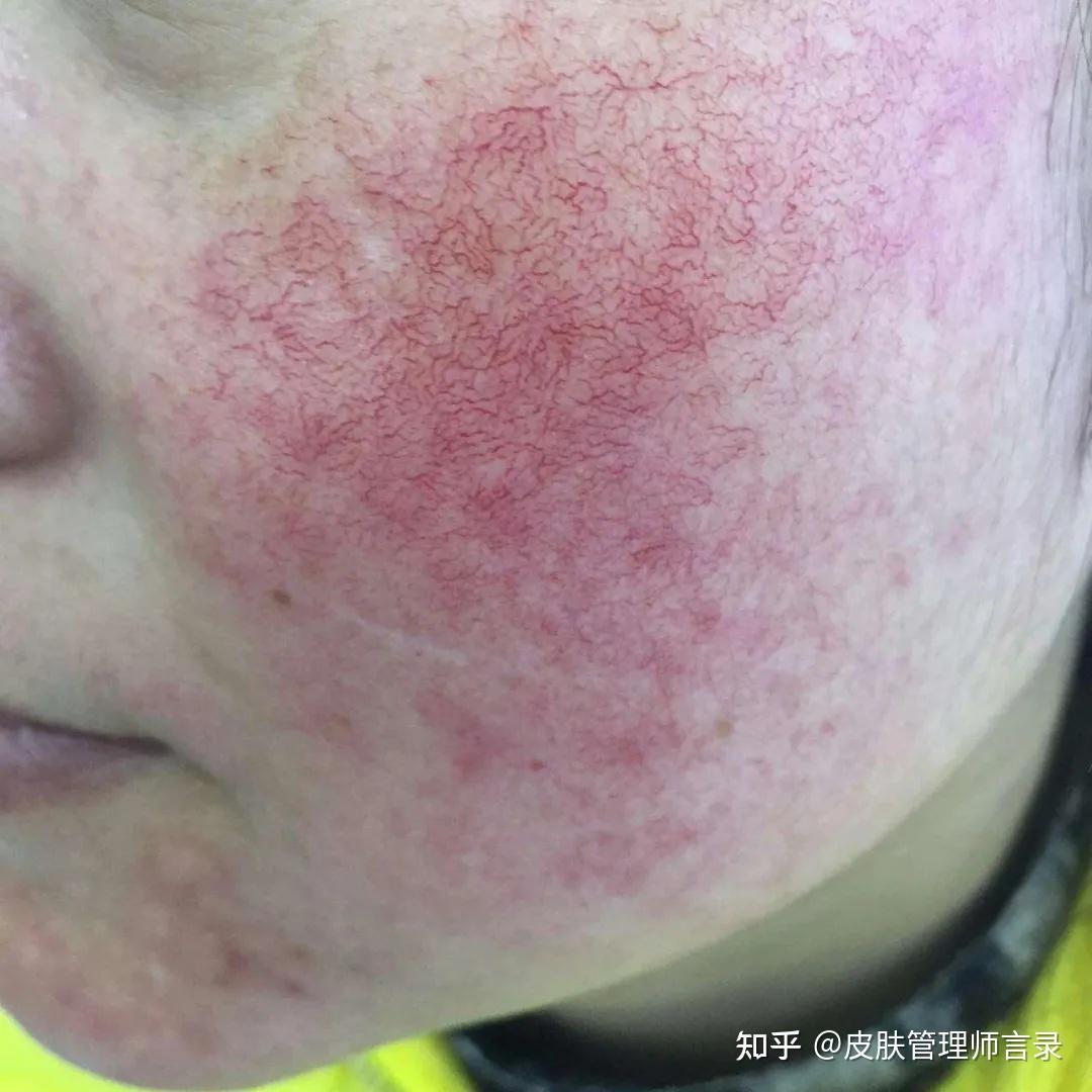 额头长痘、脸颊敏感是怎么回事？ - 知乎