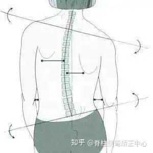 重磅 | 央视专题报道:我国中小学生脊柱侧弯人数已超500万! - 知乎