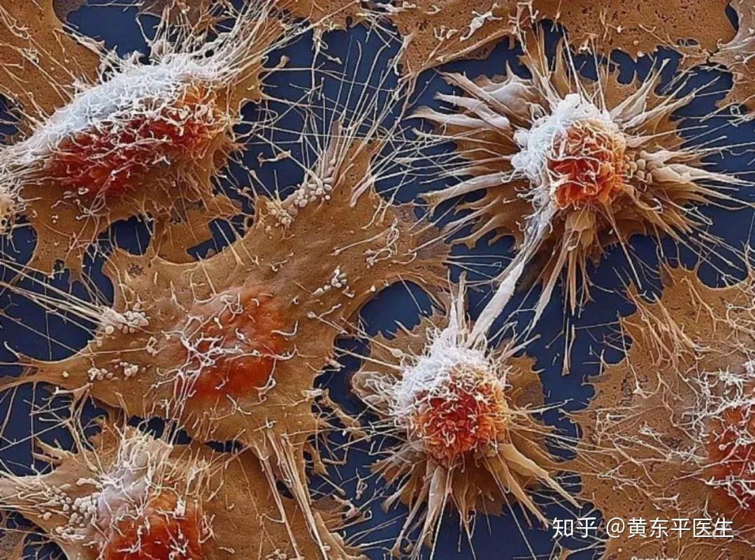 所谓的癌症,就是体内的基因变异导致细胞突变,成为恶性肿瘤