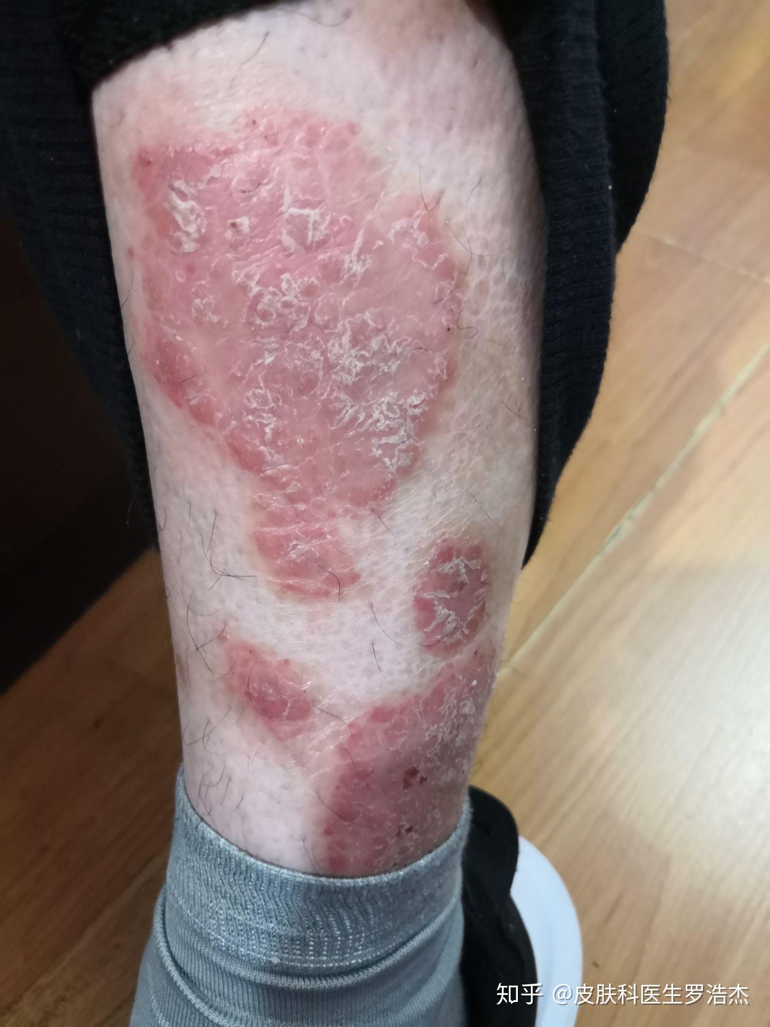 再看,那些斑块型银屑病或大斑块型银屑病,发病日久,原因不能确定,与