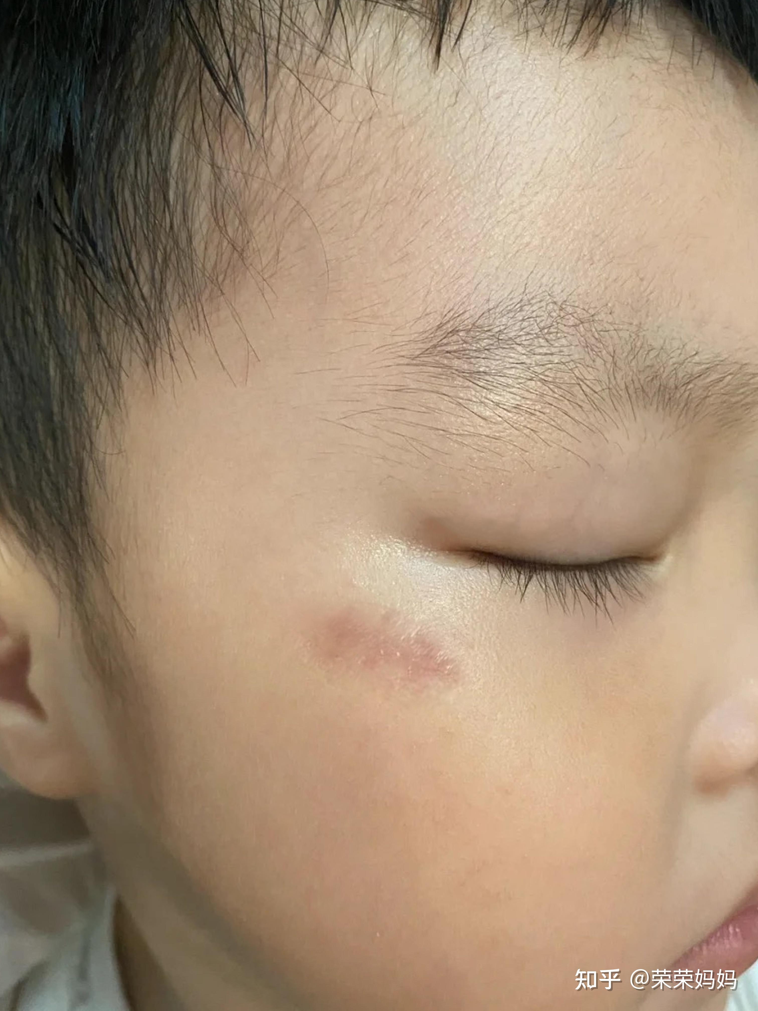 婴儿脸划伤会留疤痕吗（孩子被抓伤脸）-幼儿百科-魔术铺