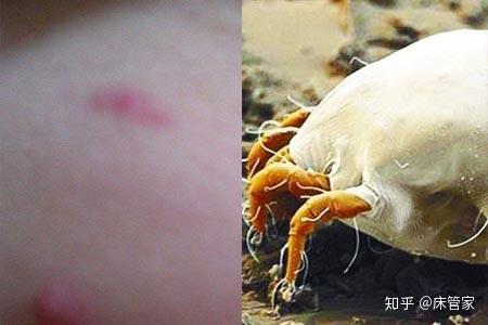 螨虫叮咬后会出现什么症状