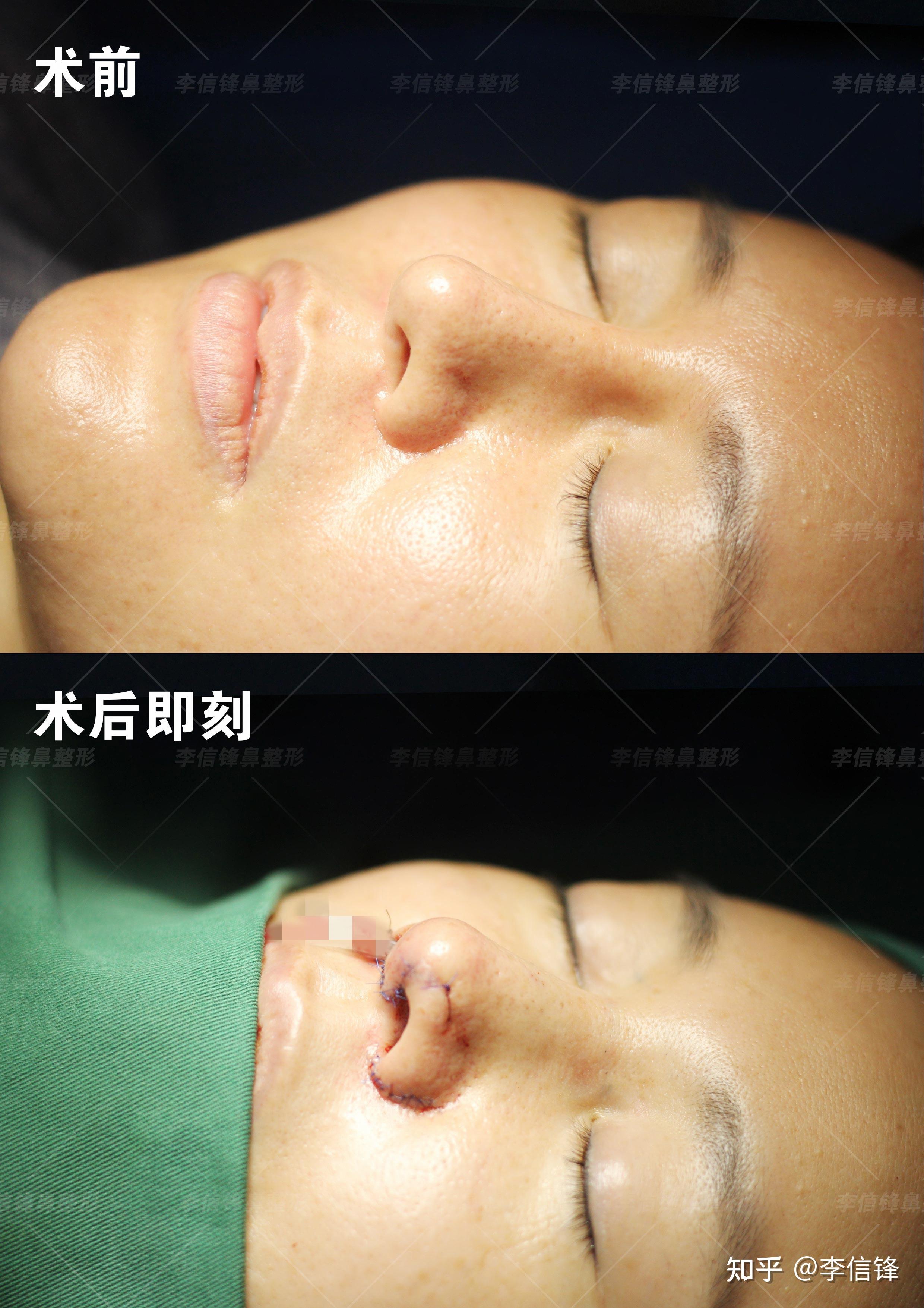 超体肋软骨鼻修复案例术后即刻对比分享深圳李信锋隆鼻整形案例