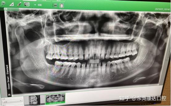 医学科普关于正畸你了较多少快来和小v一起了解吧