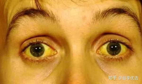 眼球发黄是怎么回事 知乎