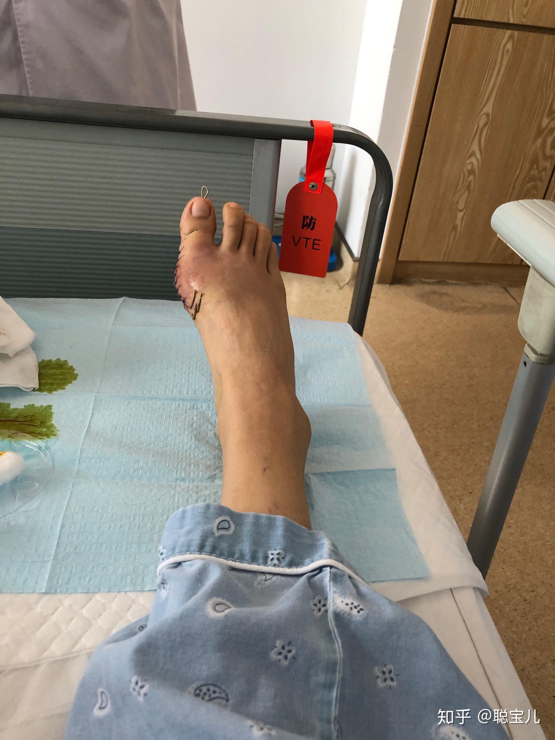 传统拇外翻手术