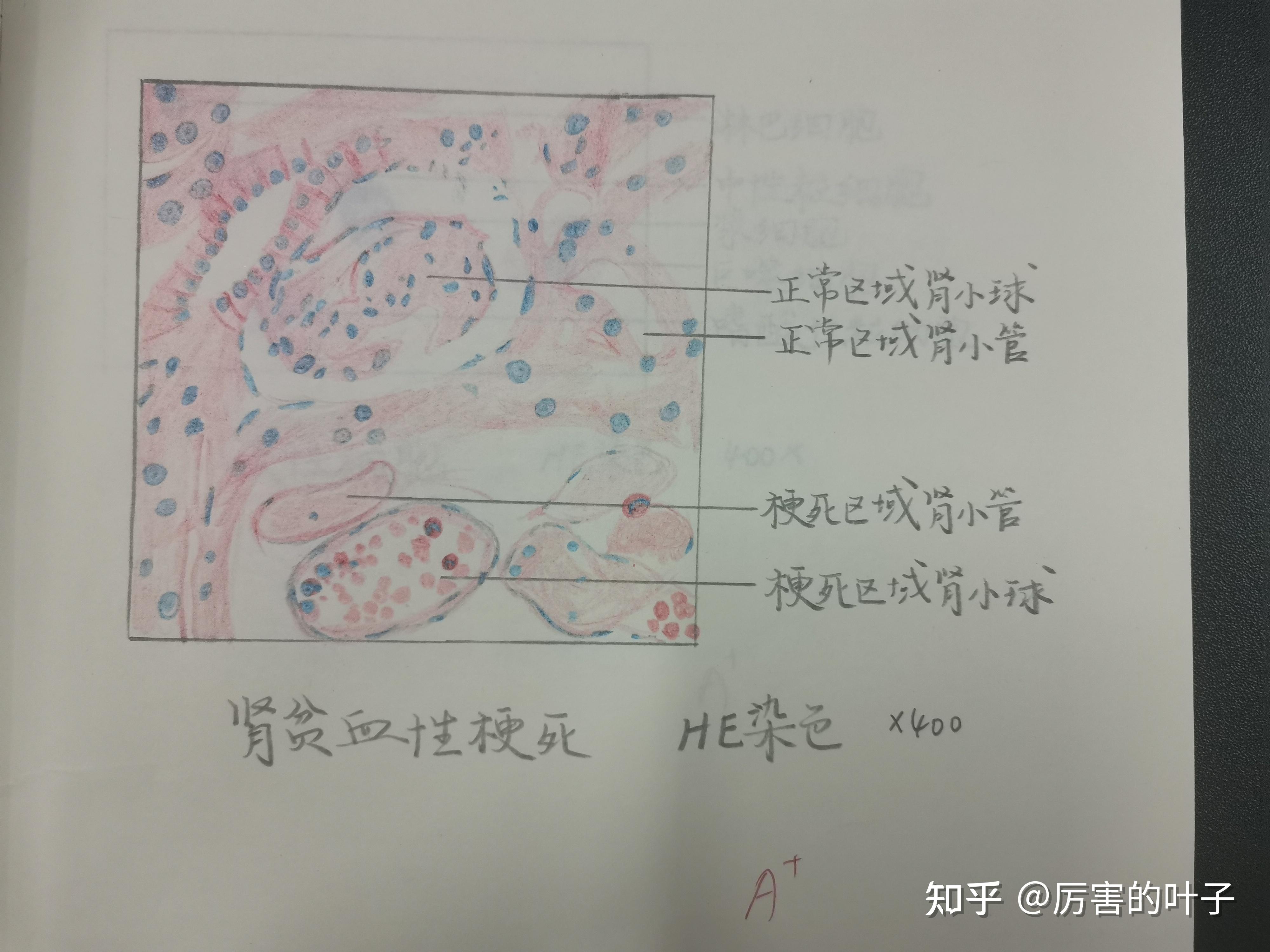 肾贫血性梗死手绘图图片