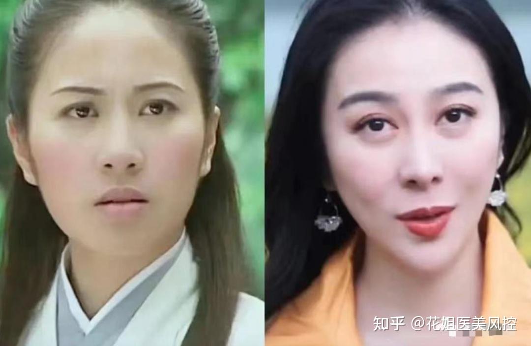众女星难逃的医美魔咒:第一代"蔡明",第二代"刘嘉玲"?