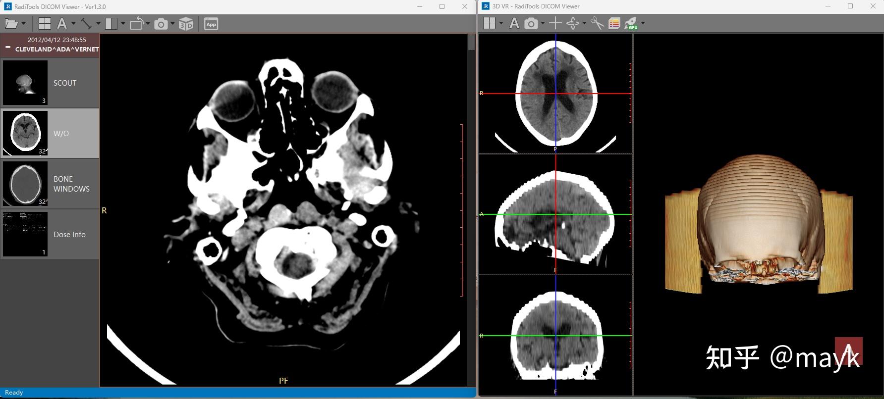 Radviewer RadiAnt与RadiTools两个DICOM Viewer比较 - 知乎