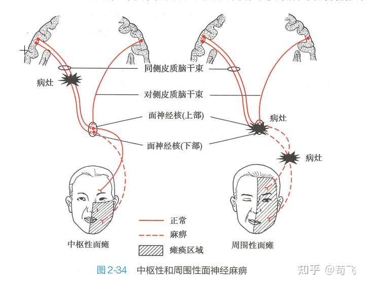 头针语言中枢图片