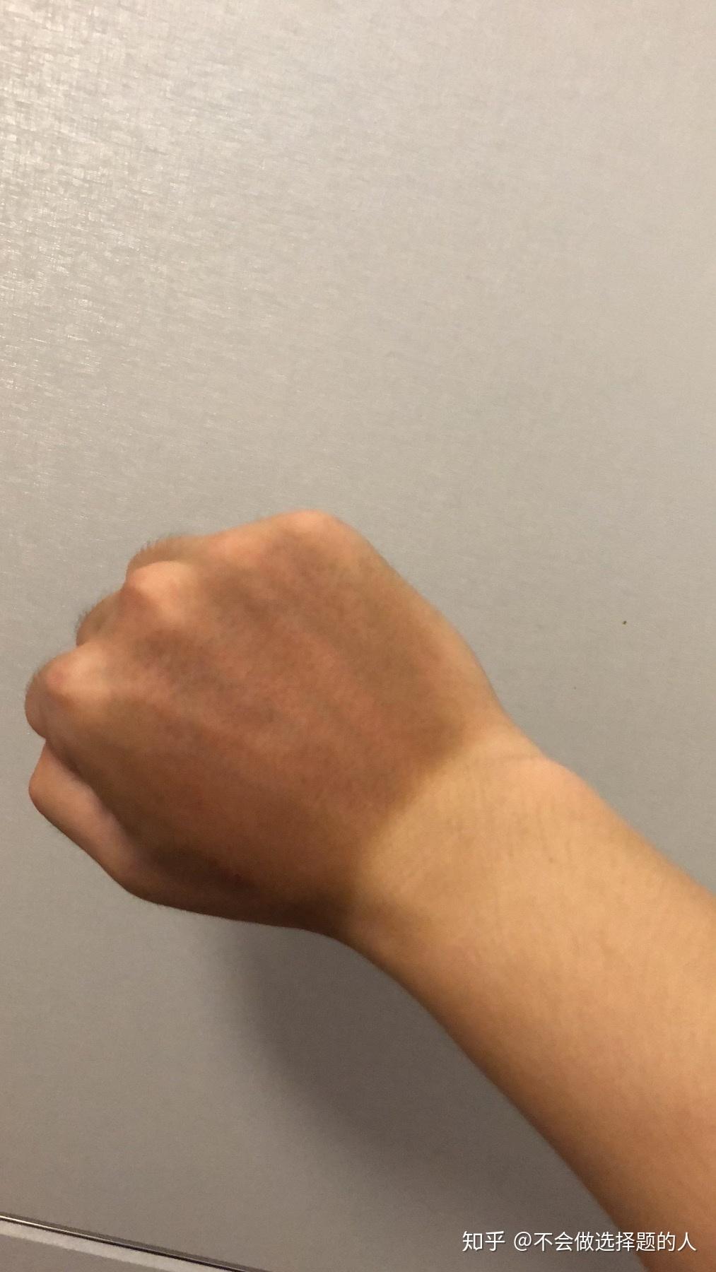 骑摩托俩小时手晒黑了还能白么