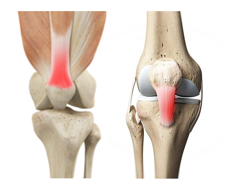 股四头肌肌腱炎症状图片