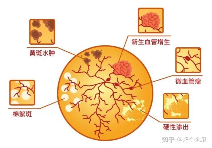 糖尿病性黃斑水腫出現病情反覆可能是這3點原因