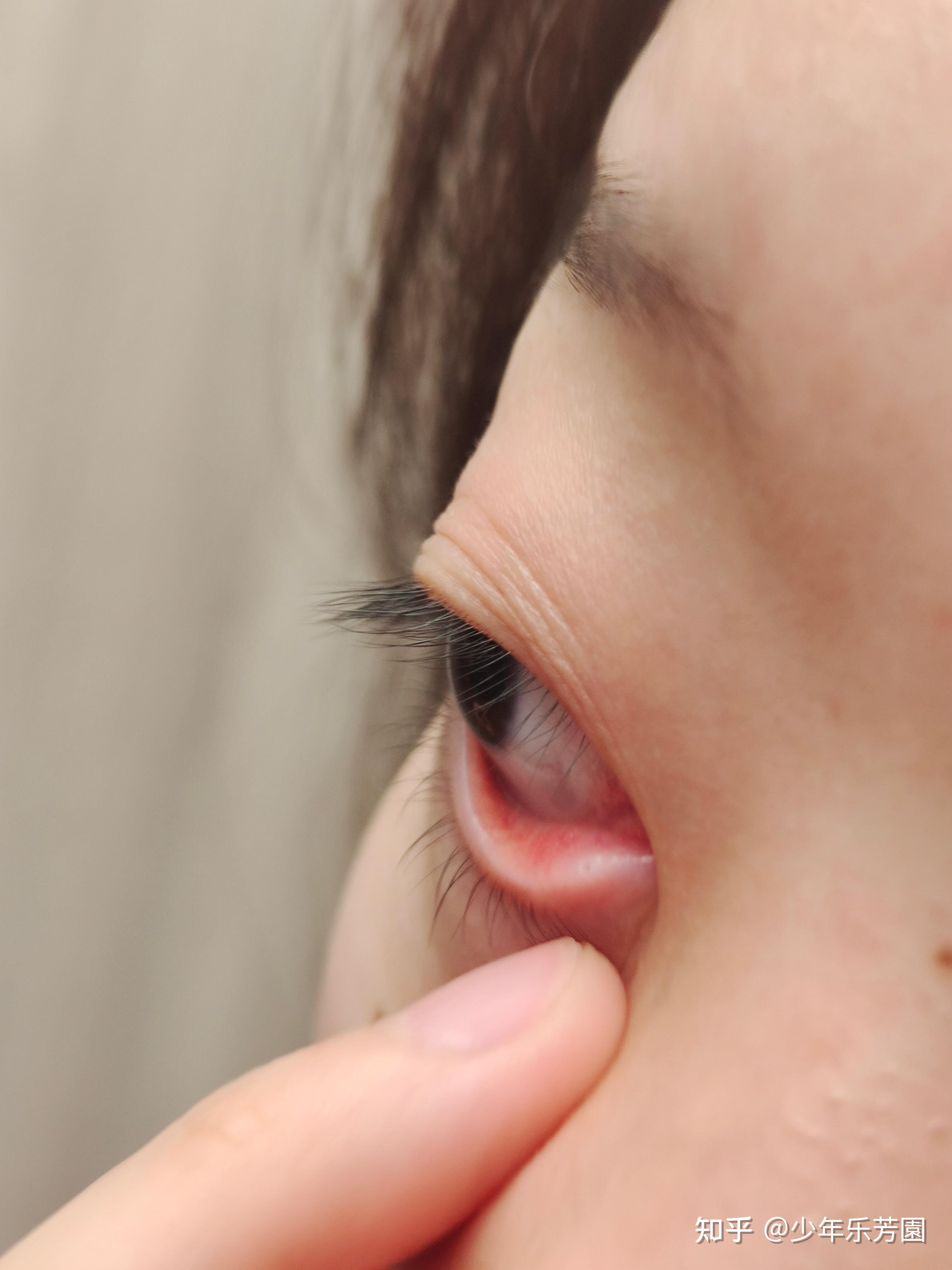 下眼睑长了一个小肉粒 - 知乎