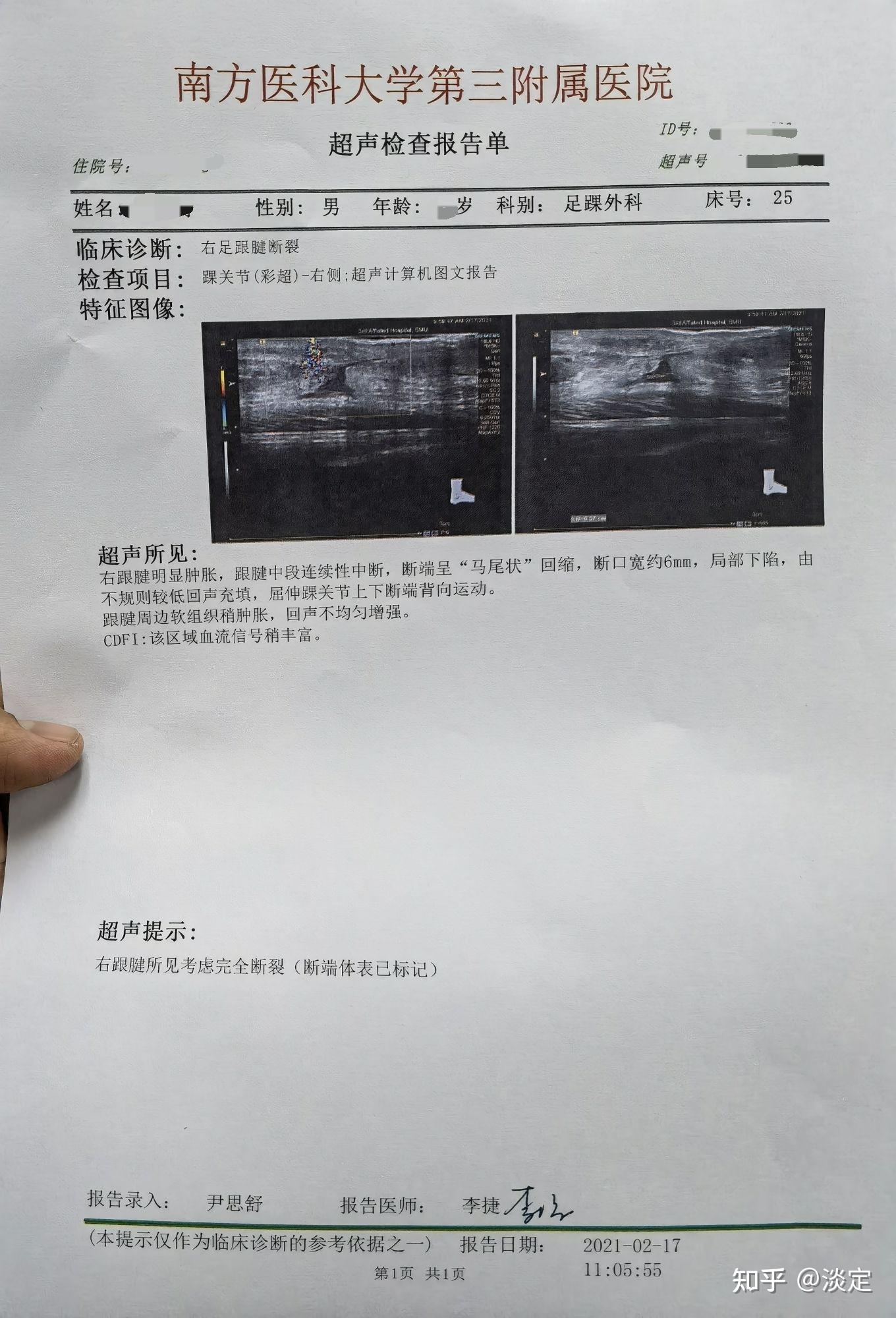 跟腱断裂病例图片图片