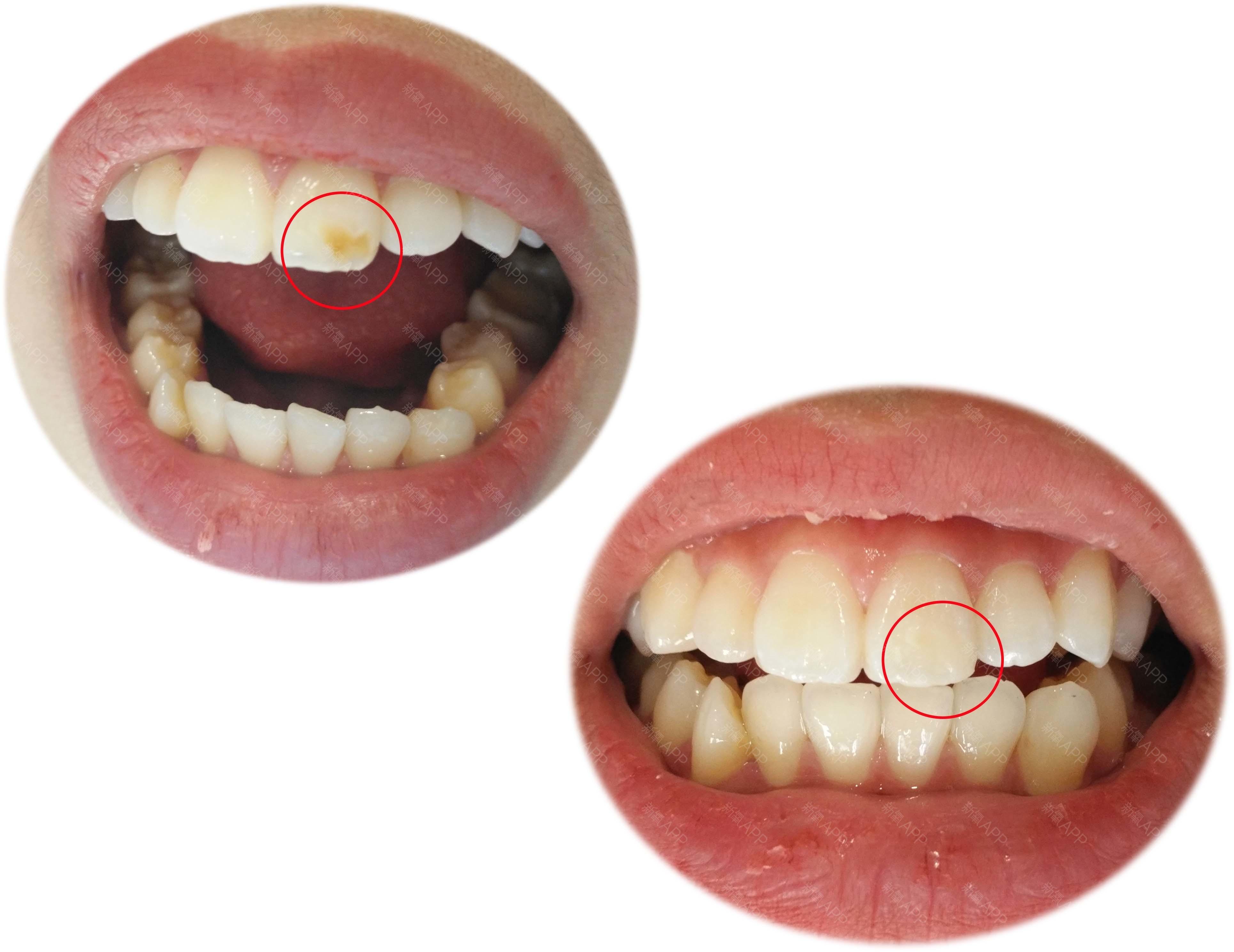 龋齿分解模型 四倍龋齿放大模型 牙齿解剖模型 牙科口腔教学模型-阿里巴巴