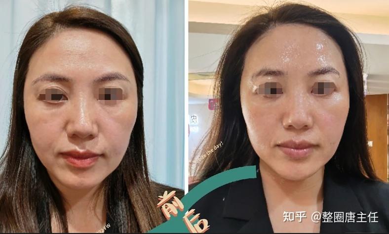 一.热玛吉和超声炮有什么区别?该如何选择?