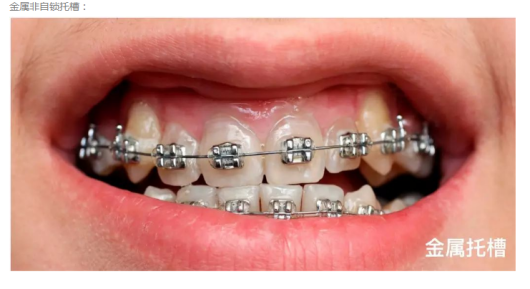 牙套有哪些类型?牙齿矫正的流程是什么?