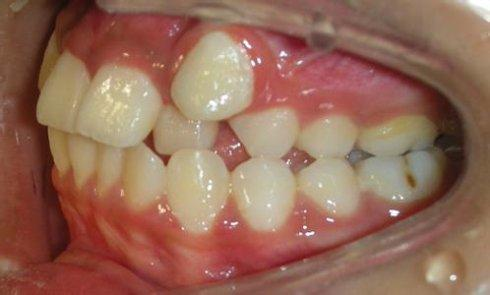 南京牙齿矫正南京正畸在南京做牙齿矫正有哪些靠谱医生和医院戴牙套