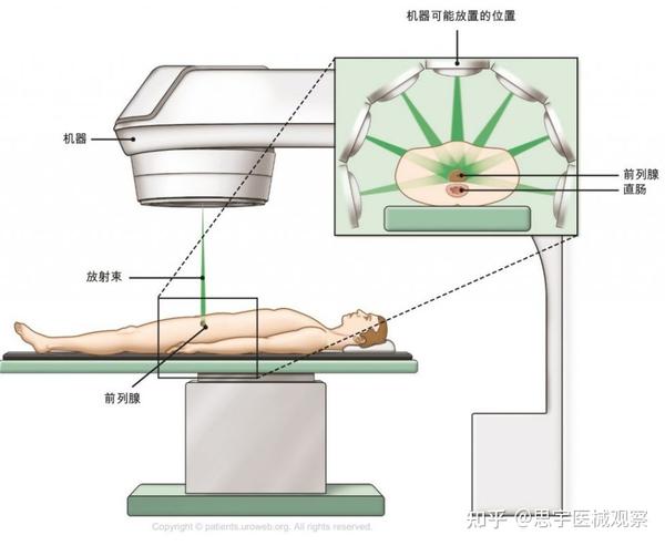 得了前列腺癌怎么办常见治疗方式及相关医疗器械器械兵器谱 知乎