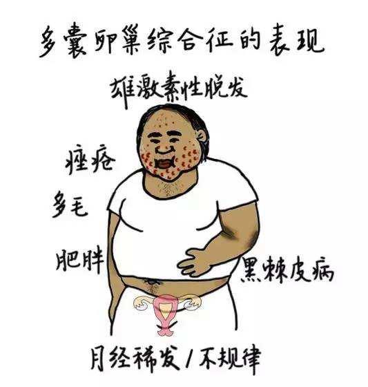 多囊卵巢与桥本甲减系列之一密不可分的联系