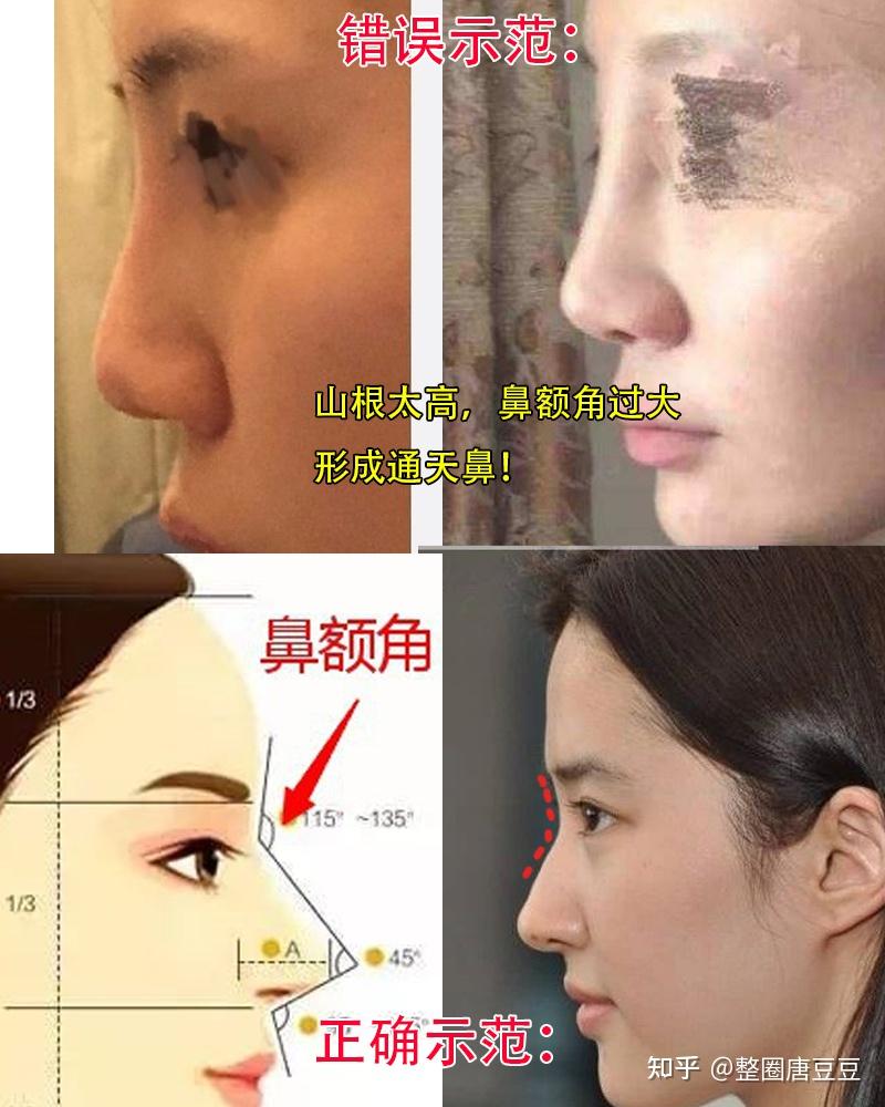 业内人告诉你,怎么选对隆鼻医生?如何判断医院靠不靠谱?隆鼻必看 - 知乎