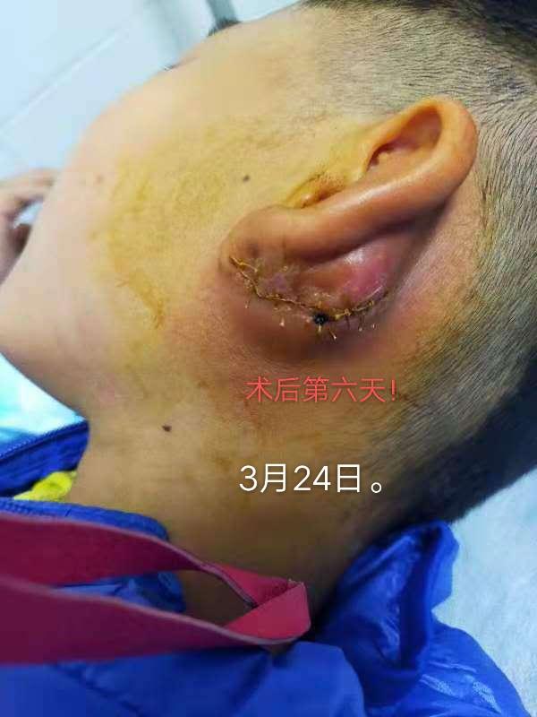 深圳8岁儿童先天性耳前瘘管手术失败之始末