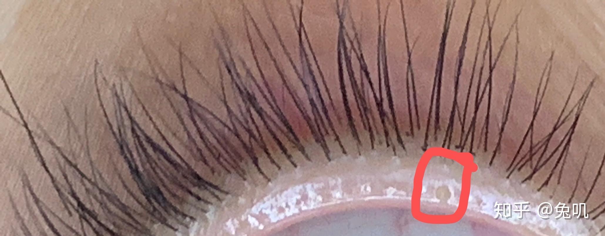 眼睛睫毛根部长疙瘩不痛不痒用手可以扣掉类似痘痘的这是什么