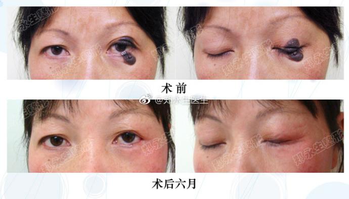 67眼睑分裂痣为先天性发生于上下眼睑的色素痣