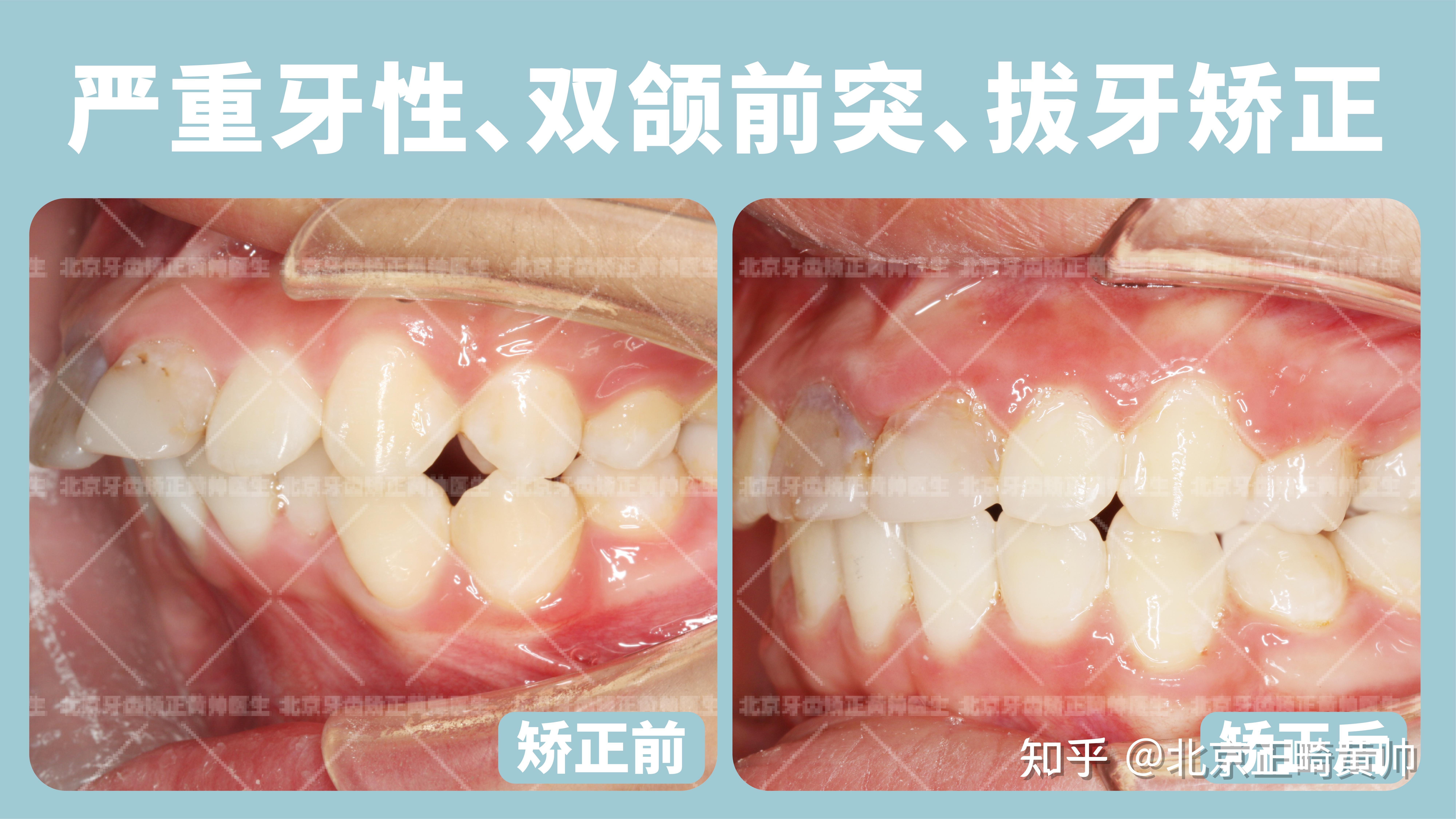 牙齿矫正常见嘴凸的5种类型你是哪一种