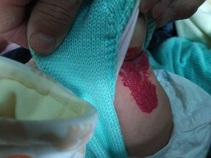 脚部草莓状血管瘤能自行消退吗