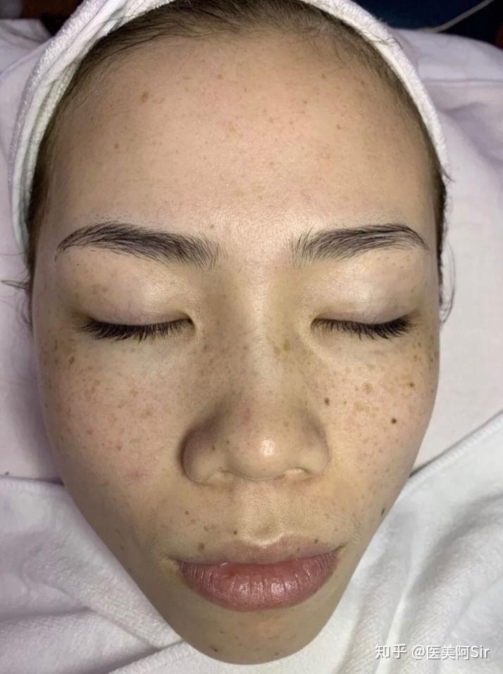 除此之外,还有好多晒斑,是不是有遗传性斑的人都特别容易长晒斑啊,好