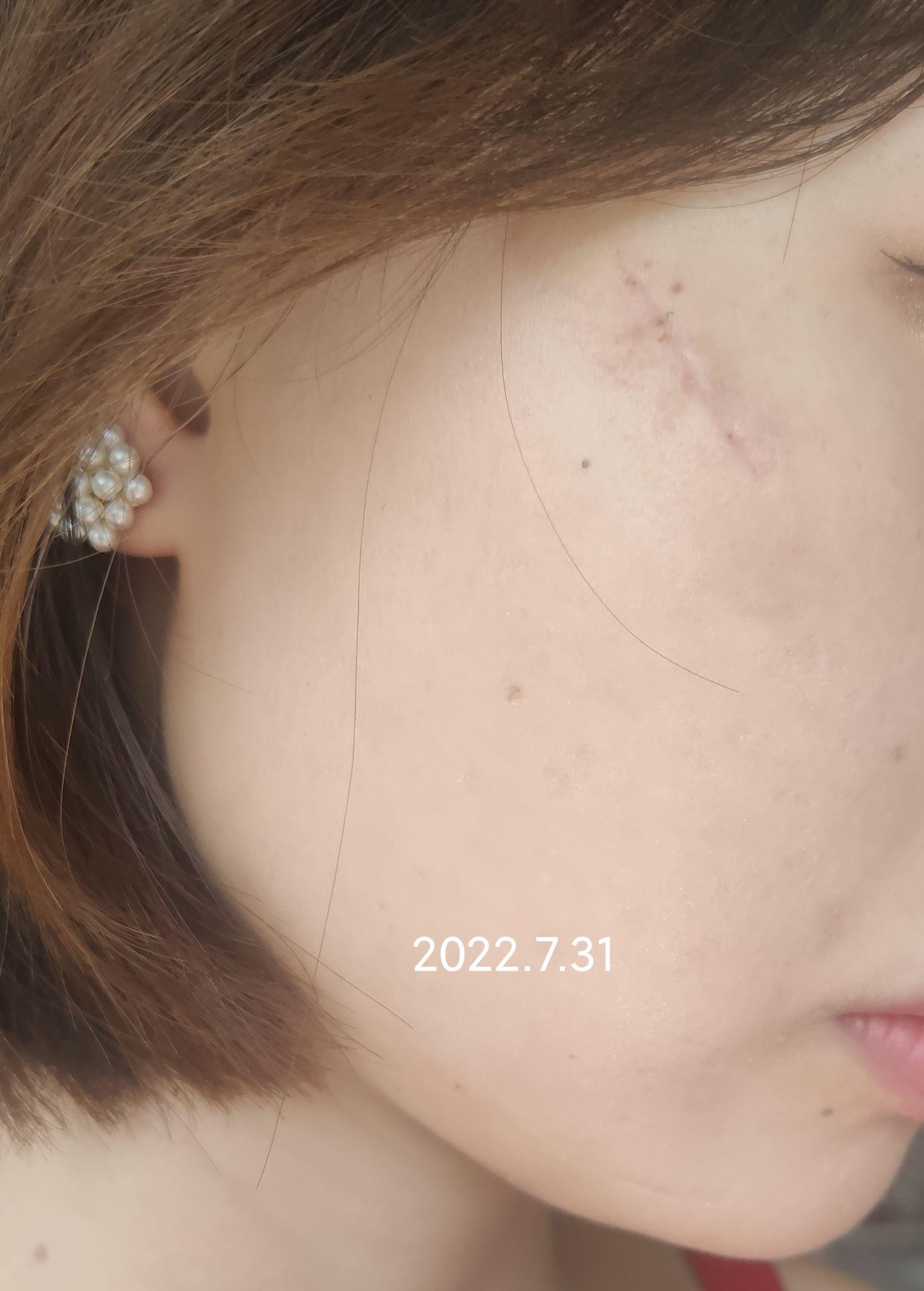 面部凹陷性疤痕修复(自体脂肪填充1次 3次点阵激光 1次手术切缝)