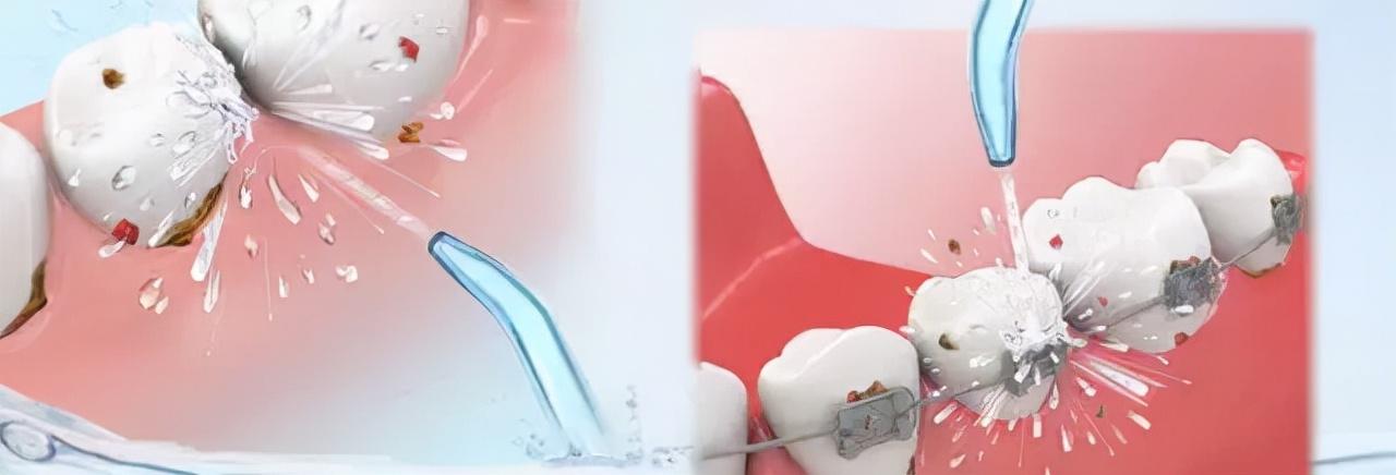 牙签剔牙不靠谱吗那什么才是牙缝清洁的最佳选择