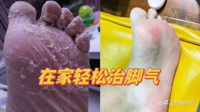 脚臭脚痒烂脚!一个简单方法治愈千万脚气患者,居家操作省钱安心! - 知乎