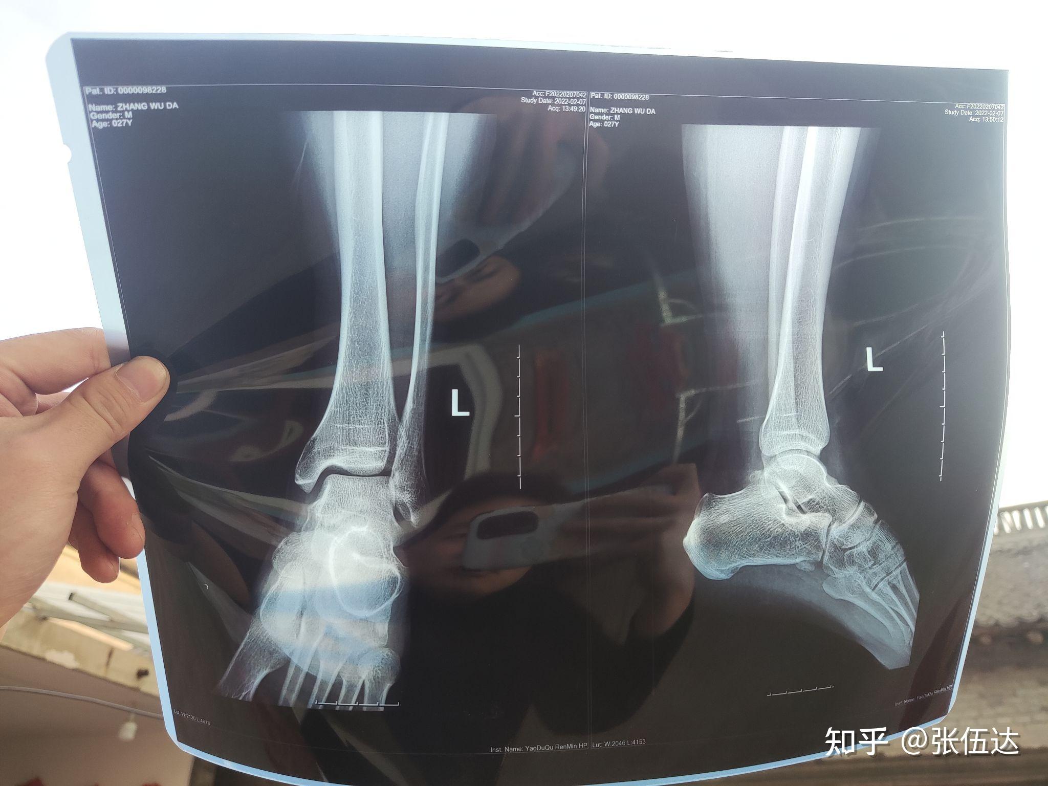 求足踝关节骨科专家远程会诊